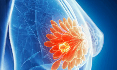 Baixa procura por mamografia dificulta diagnóstico precoce do câncer de mama no Brasil